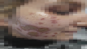 Yüzüne kimyasal madde atılan şiddet mağduru kadın, yaşadıklarını AA'ya anlattı: